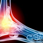 How Can I Stop Foot Pain?