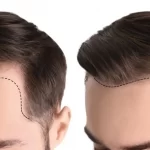 Hair-Transplant