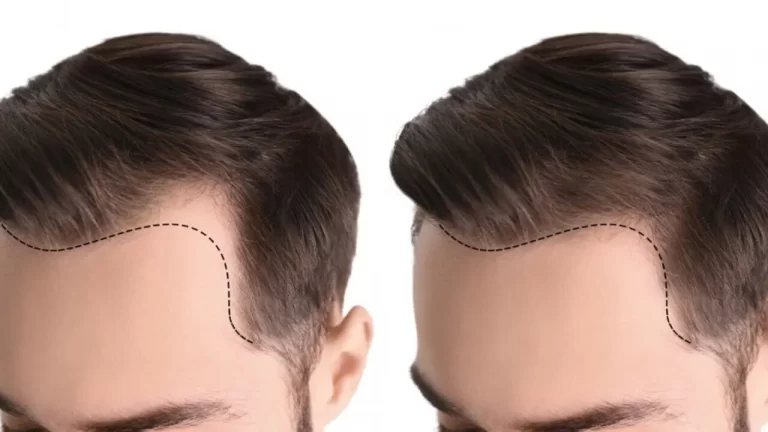 Hair-Transplant