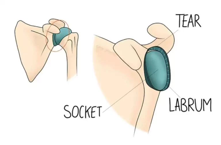 Treatment of Frozen Shoulder Using Manual Techniques, Including the Niel-Asher Technique