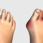 Lapiplasty Bunion Surgery