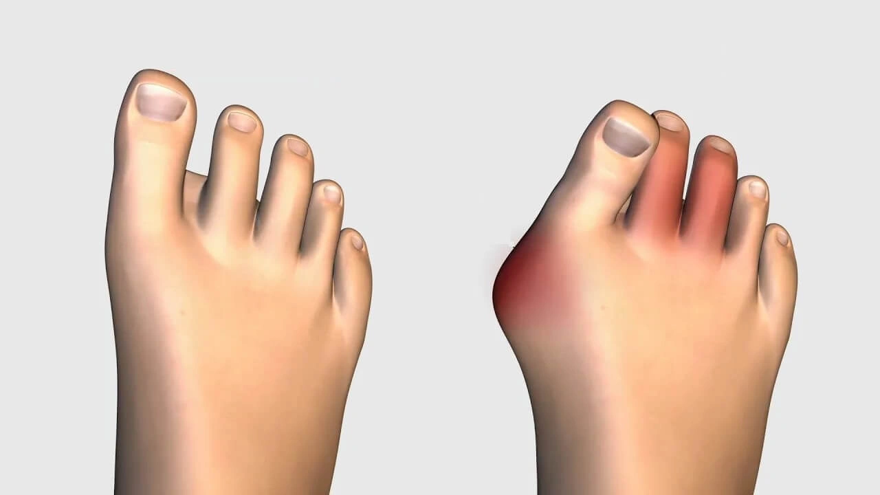 Lapiplasty Bunion Surgery