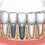 How Screwless Dental Implants Improve Your Smile