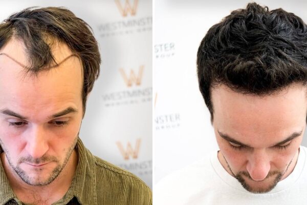 Hair Transplant