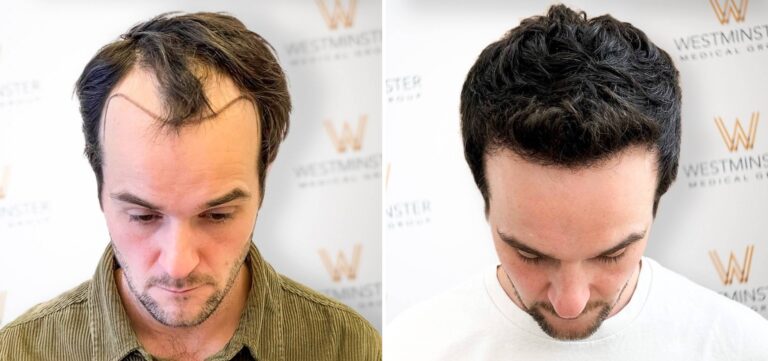 Hair Transplant