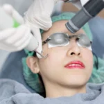 Pico Laser Treatment